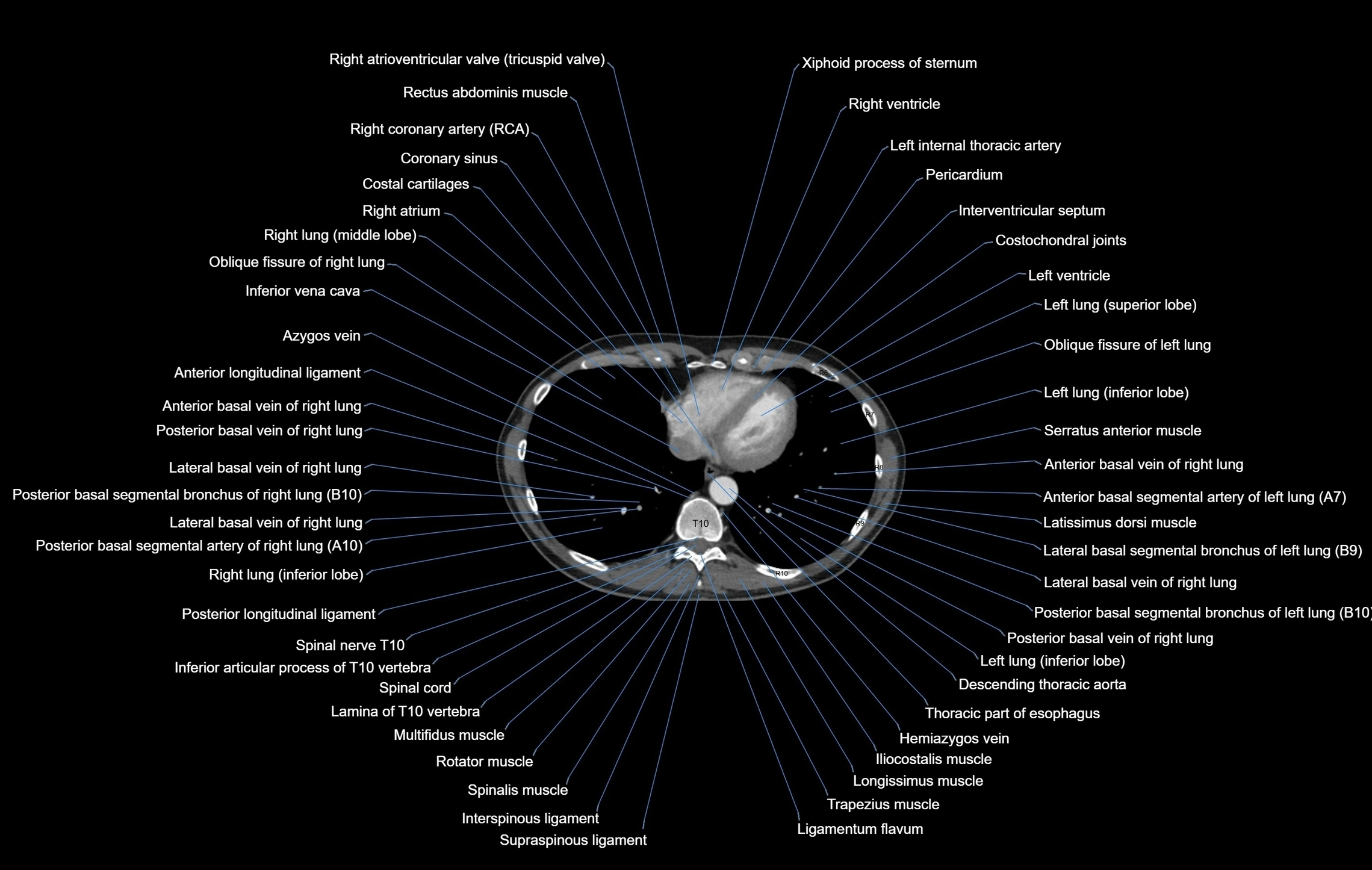 CT chest (thorax) soft tissue window labelled axial cross sectional anatomy radiology image-00090.webp